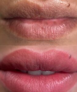 LIP REVITALIZATION