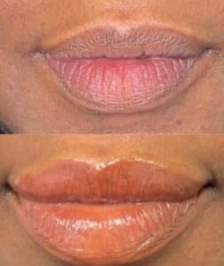 LIP NEUTRALIZATION